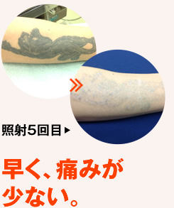 早く、痛みが少ない