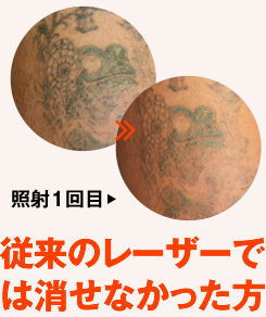 従来のレーザーでは消せなかった方