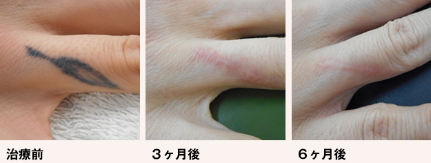 治療前 ３ヶ月後 ６ヶ月後