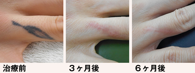 治療前 ３ヶ月後 ６ヶ月後
